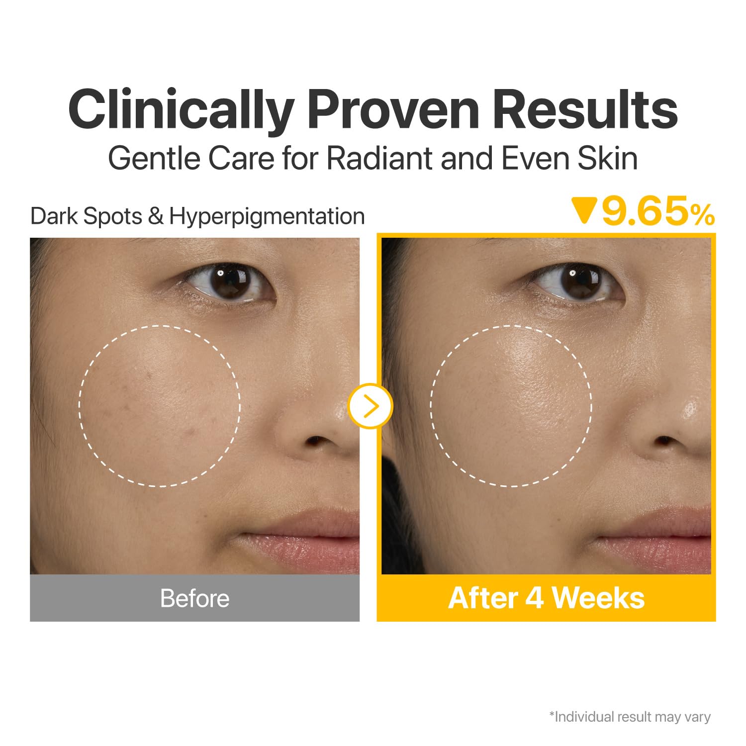 Numbuzin No.5 Serum | Tranexamic Acid 4%, Niacinamide 5%, Glutathione, Vitamin C | Vitamin Concentrated Serum | Hyperpigmentation| Suitable for Sensitive Skin, Korean Skincare | 1.01 fl. oz.