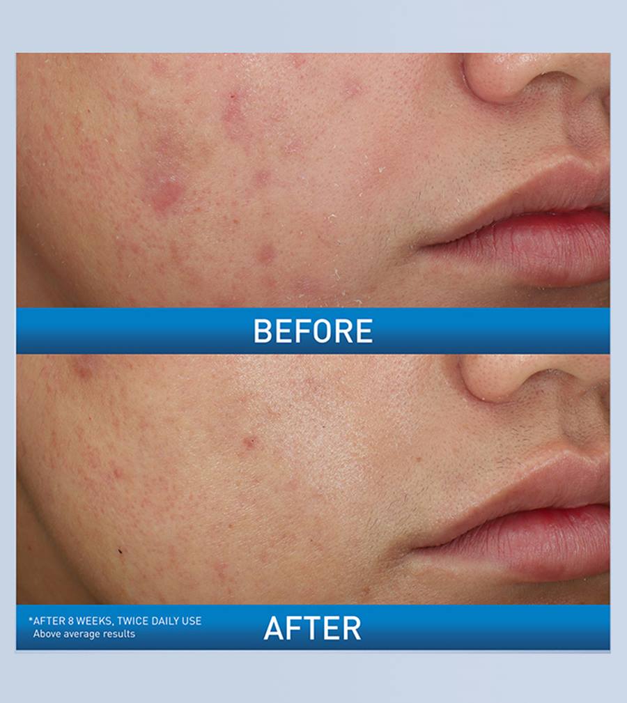 CeraVe Acne 10% Benzoyl Peroxide Foaming Cream Wash 150 ML